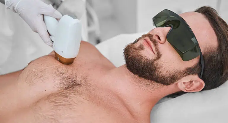 erkek lazer epilasyon görseli